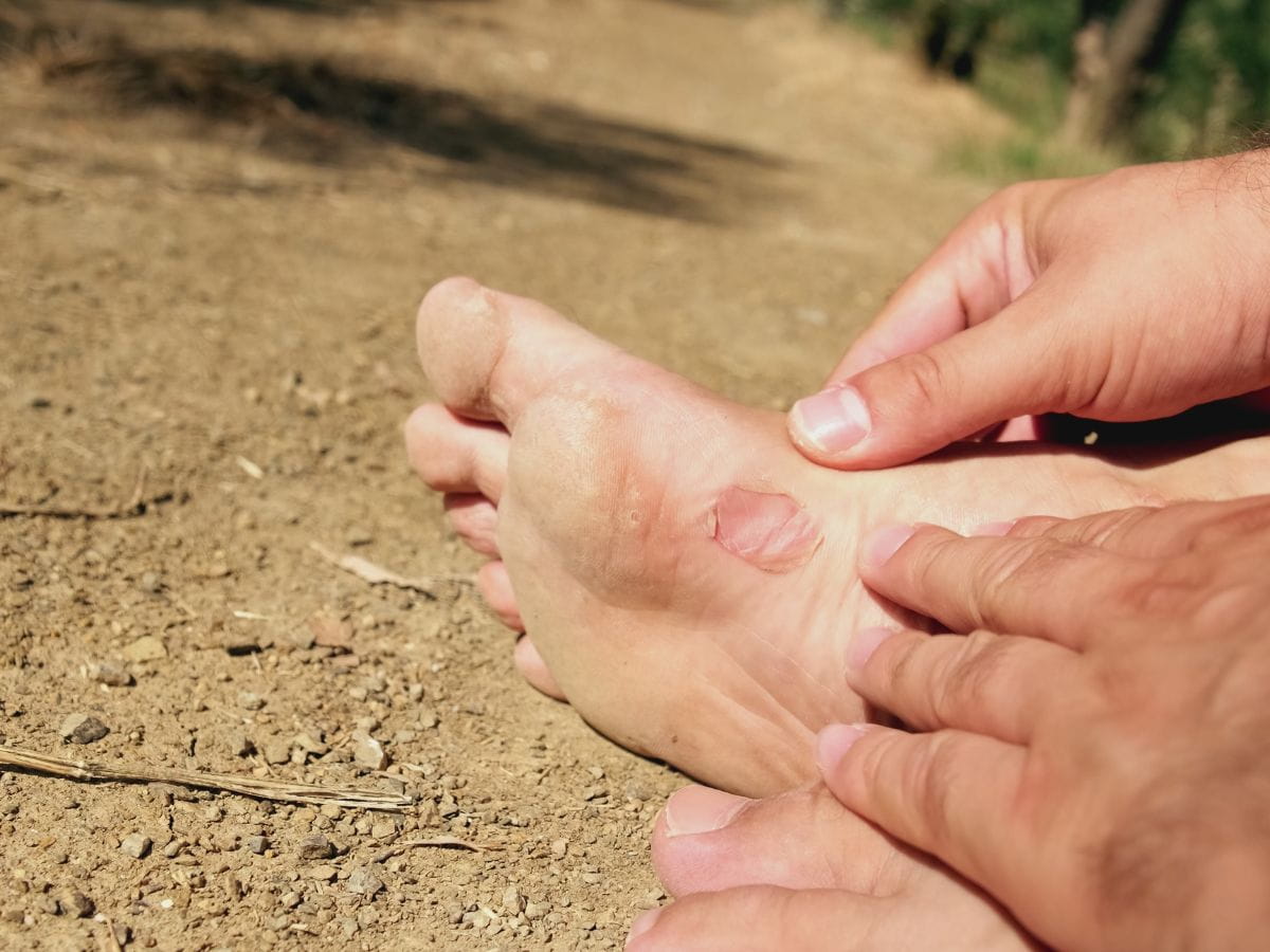 Foot blister on a hiking trail, showing how to stop blisters when hiking.